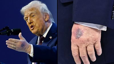 الأسبرين أم الارتطام.. ترامب يكشف للصحفيين سر 