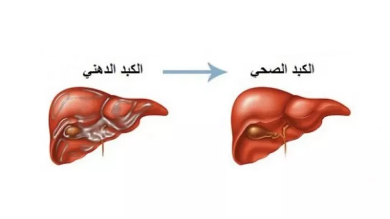 الكبد الدهني