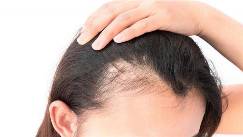 علاج للثعلبة ومشاكل