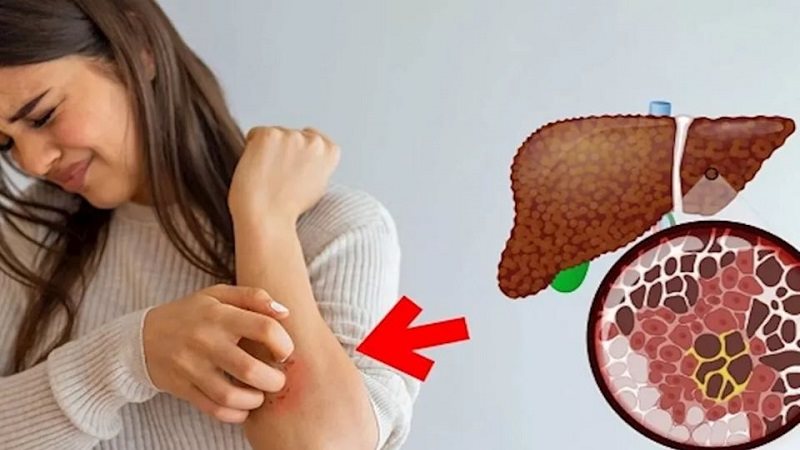 أمرض كبد دهني في