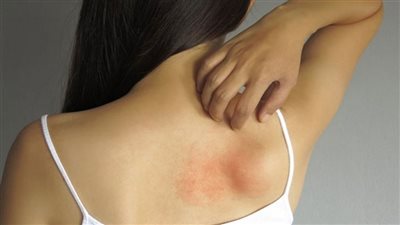 ماذا يحدث داخل الجسم قبل الإصابة بالحزام الناري؟.. استشار يكشف مفاجأة|فيديو